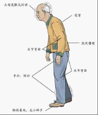帕金森临床症状 帕金森临床症状
